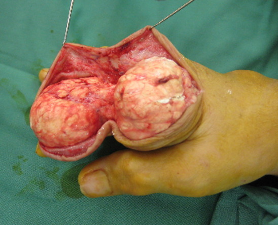 Pictures Of Gout 8