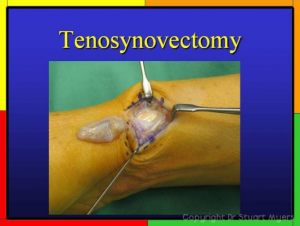Extensor Tendon Anatomy at Wrist